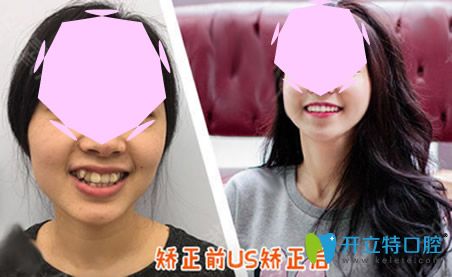 成都?xì)g悅口腔隱形矯正術(shù)前術(shù)后對(duì)比案例
