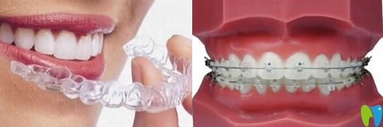 活動矯正器和固定矯正器有什么區(qū)別