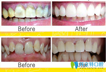 黃圣奇3D瓷?？萄例X修復(fù)真人案例