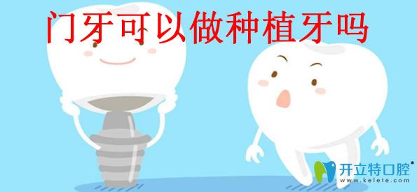 門(mén)牙缺失種植牙好不好 牙齒種植體品牌及價(jià)格的答案都在這