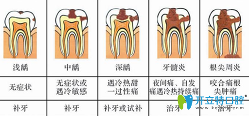 朋友說(shuō)根管戴牙套牙會(huì)變黑,建議我根管后堅(jiān)決不做牙冠,對(duì)嗎