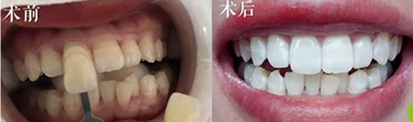 冷光美白對牙齒有危害嗎？關于為什么牙齒會變黃的小知識