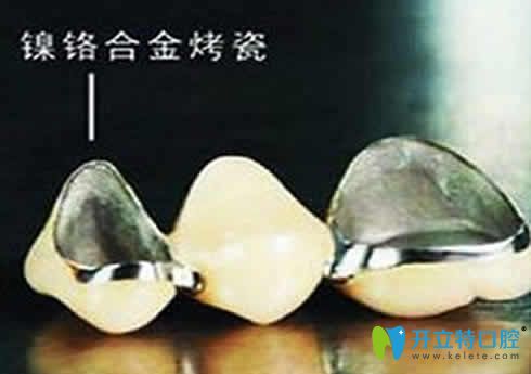 網(wǎng)上說(shuō)鎳鉻烤瓷牙會(huì)致癌是真的嗎？揭秘鎳鉻烤瓷牙的危害