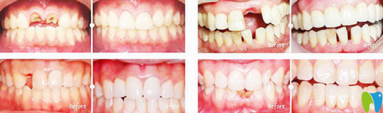 福州貝臣齒科好不好？貝臣口腔種牙真人案例效果來驗證