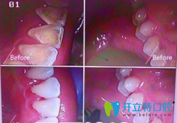 貝臣齒科超聲波洗牙前后對比照片