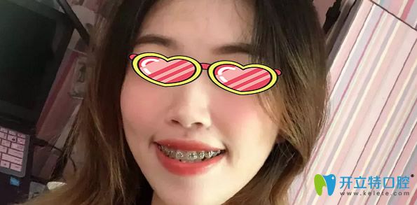 東南口腔正畸效果好不好 東南口腔正畸效果好不好