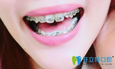 戴金屬自鎖牙套矯正牙齒第93天牙齒變化圖