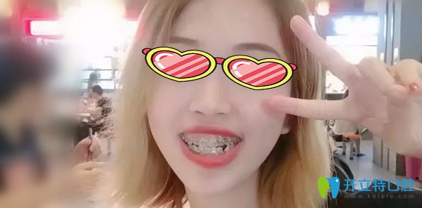 戴牙套矯正牙齒6個月恢復(fù)效果 戴牙套矯正牙齒6個月恢復(fù)效果