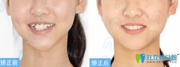 青少年安氏I類錯合固定矯治案例及對比效果