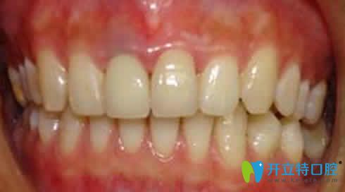 鎳鉻烤瓷牙修復圖