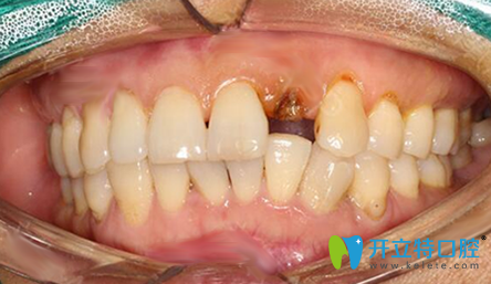 沒有去福州貝臣口腔做即刻種植牙前