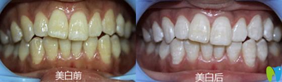 天津美萊口腔靠譜嗎？來看顧客冷光美白治療前后效果對比