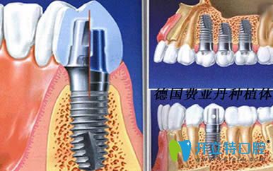 列舉德國種植牙品牌有哪些以及費(fèi)亞丹/icx/bego種植系統(tǒng)簡介