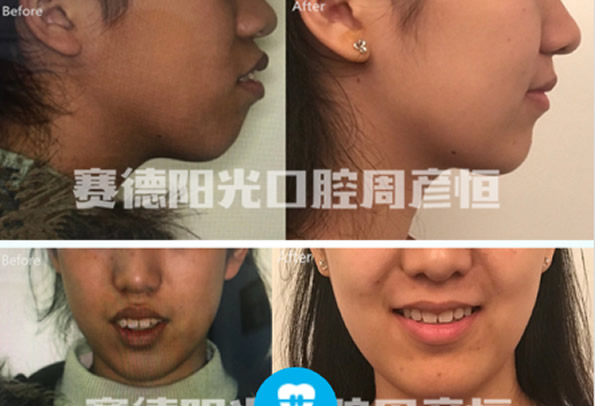 骨性齙牙怎么矯正帶牙套有用嗎 深圳賽德陽光口腔正畸貴嗎