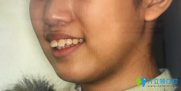 <!--<i data=20240703-sp></i>-->口腔<!--<i data=20240703-sp></i>-->矯正牙齒前
