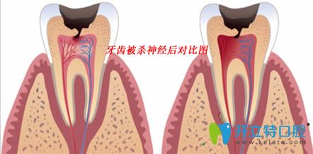 呼和浩特紅十字口腔解說牙齒摘除神經(jīng)后疼痛的原因與對策