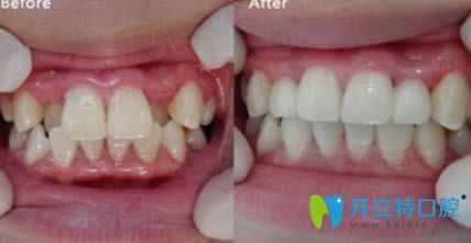 呼和浩特紅十字口腔隱適美隱形牙齒矯正前后效果對比圖 呼和浩特紅十字口腔隱適美隱形牙齒矯正前后效果對比圖