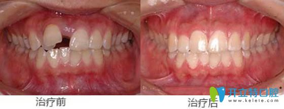 屬于天津美萊口腔的牙齒錯(cuò)位、牙間縫矯正案例