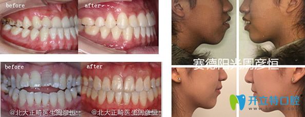 骨性齙牙正畸案例+牙齒咬合不齊矯正前后效果對比圖 骨性齙牙正畸案例+牙齒咬合不齊矯正前后效果對比圖