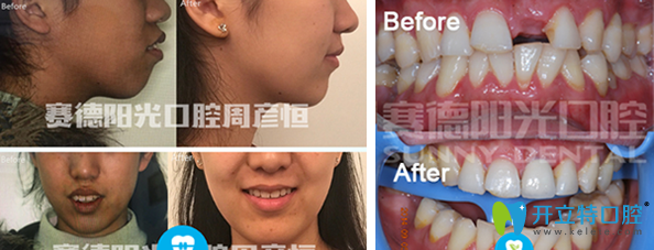 <!--<i data=20240703-sp></i>-->口腔正畸+種植牙效果案例 <!--<i data=20240703-sp></i>-->口腔正畸+種植牙效果案例