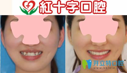 呼和浩特紅十字口腔好嗎?有隱適美隱形牙齒矯正案例可參考
