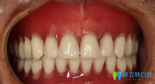 在杭州美奧口腔做完全口即刻種植牙后的照片