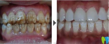 呼和浩特紅十字口腔魏東醫(yī)生牙齒瓷貼面效果圖 呼和浩特紅十字口腔魏東醫(yī)生牙齒瓷貼面效果圖