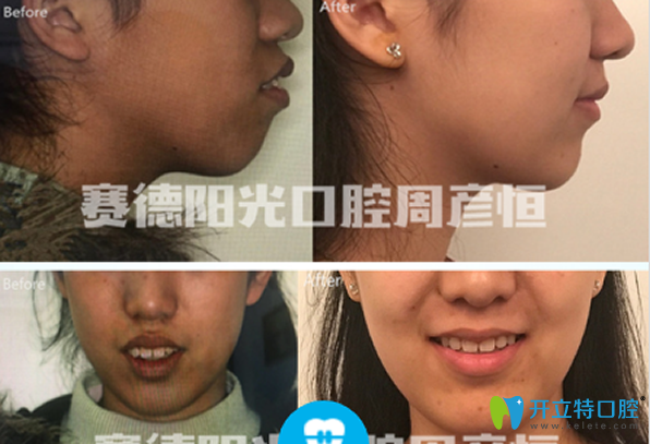 <!--<i data=20240703-sp></i>-->口腔骨性齙牙矯正前后效果對(duì)比