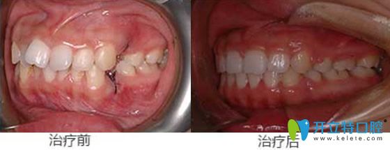 天津美萊口腔牙齒擁擠鎖頜矯正案例對(duì)比圖