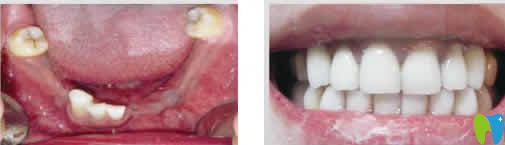 蘭州惠安齒科冉俊杰種植牙案例效果圖 蘭州惠安齒科冉俊杰種植牙案例效果圖