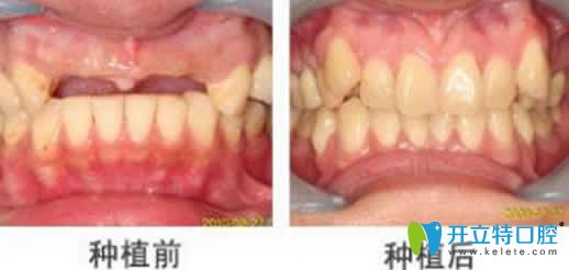 蘭州惠安齒科種植牙圖