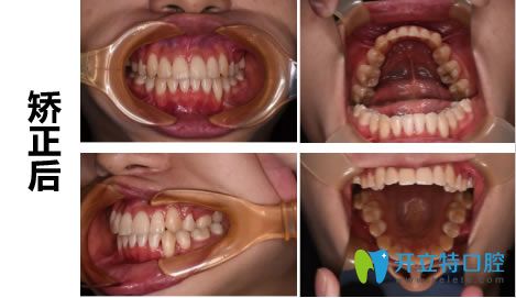 戴隱形牙套19個月后的正畸效果 戴隱形牙套19個月后的正畸效果
