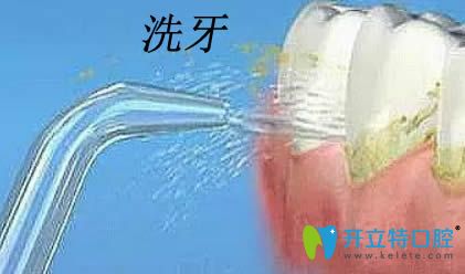 美白牙齒—烤瓷牙/冷光美白方法比較由大連昭鶴口腔提供