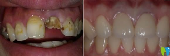 大連昭鶴口腔李文顏牙齒修復(fù)效果圖 大連昭鶴口腔李文顏牙齒修復(fù)效果圖