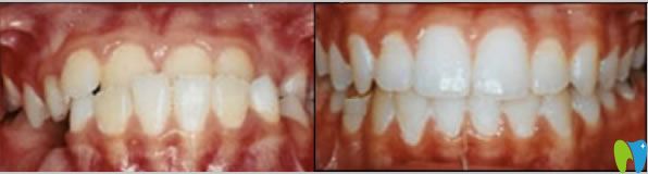 長(zhǎng)沙愛思特口腔彭斌醫(yī)生地包天矯正案例 長(zhǎng)沙愛思特口腔彭斌醫(yī)生地包天矯正案例