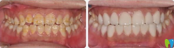 愛思特超薄瓷貼面修復(fù)案例及對比圖