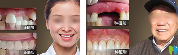 德韓口腔<!--<i data=20240703-sp></i>-->國種植牙及正畸效果案例 德韓口腔<!--<i data=20240703-sp></i>-->國種植牙及正畸效果案例