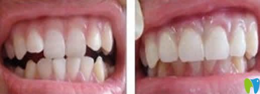 蘭州惠安齒科牙齒矯正前后對比圖