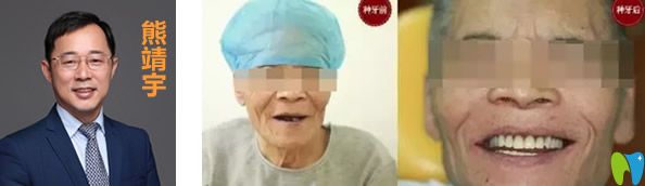 北京拜博口腔熊靖宇全口牙缺失種植效果案例