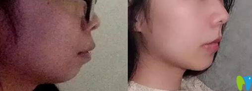 用我在長(zhǎng)沙科爾雅臉型變化圖來(lái)驗(yàn)證骨性齙牙矯正有效果嗎