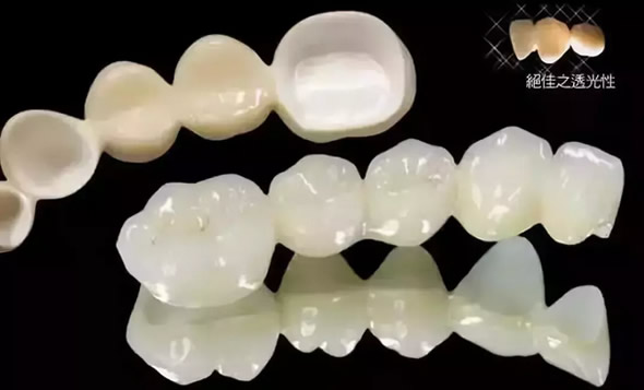 為什么全瓷牙價格比烤瓷牙貴