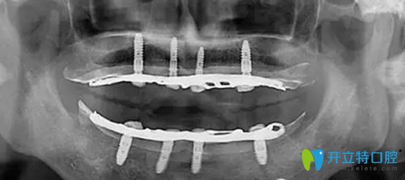全口數(shù)字化X光影像 全口數(shù)字化X光影像