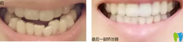 武漢德韓口腔矯牙前后效果對比
