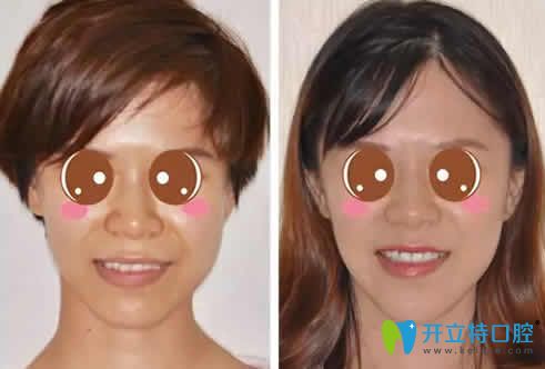 我在蘭州惠安齒科做牙齒矯正前后對(duì)比照片