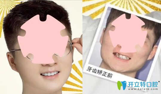 去珠海愛思特口腔做牙齒不齊、個別反頜矯正案例對比圖