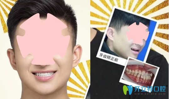 在珠海愛思特口腔做地包天矯正案例前后效果對比