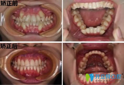 28歲的小張矯正牙齒前后對比照片 28歲的小張矯正牙齒前后對比照片