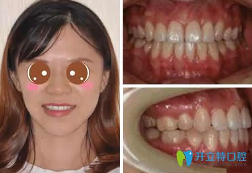 我在蘭州惠安齒科做隱形矯正一年的效果