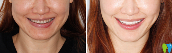 珠海愛思特口腔3D超薄瓷貼面修復(fù)案例效果對(duì)比