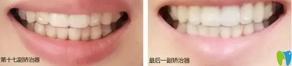 第17幅矯治器和第25幅矯正器牙齒的變化